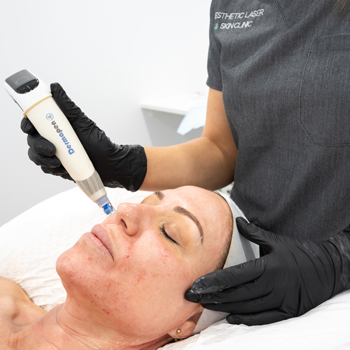Microneedling Dermapen 4™, Skin Treatments, Aesthetic Laser and Skin Clinic